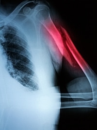 X-ray image of a severe fracture of upper arm bone. Fractura corporis humeri - pseudoarthrosis.