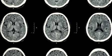 CT scans of the brain
