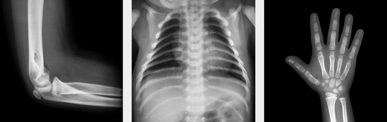 Paediatric elbow x-ray, Paediatric chest x-ray, Paediatric hand x-ray