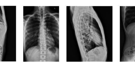 x-ray images of chest and spine