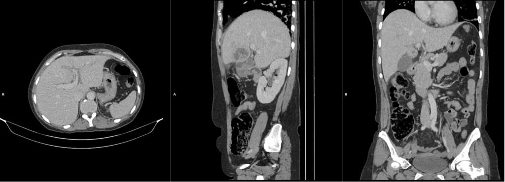 CT abdomen in axial, sagittal and coronal planes